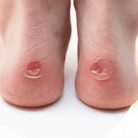 Foot Foundation podiatry treatment for foot blisters with sterile drainage, dressings, and prevention strategies for sport and daily comfort