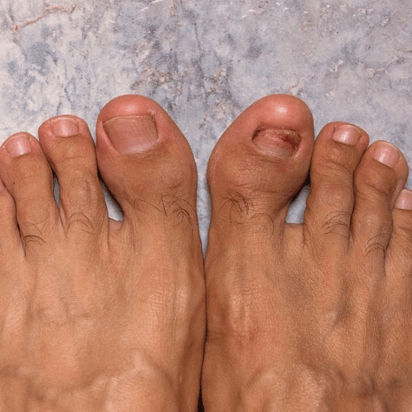 Foot Foundation podiatry treatment for turf toe with stiff-sole protection, orthotics, rehabilitation, and imaging referral