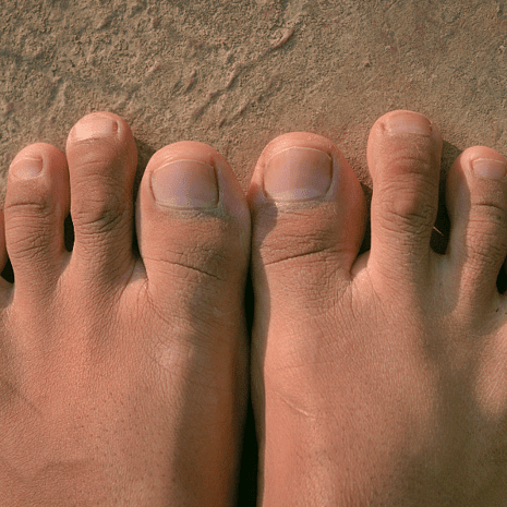 Specialist podiatry care for claw toes with silicone props, orthotics, strengthening, and footwear optimisation at Foot Foundation