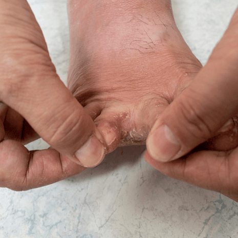 Foot Foundation podiatry care for athlete&rsquo;s foot with antifungal treatment, footwear advice, and hygiene strategies to stop reinfection