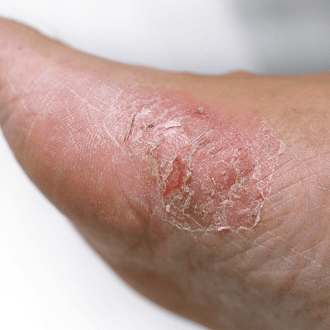 Foot Foundation podiatry care for skin infections and dermatitis with antifungal or antibacterial treatment, dressings, and prevention strategies