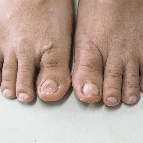 Specialist podiatry treatment for damaged and trauma nails with nail reduction, protection, and surgical options at Foot Foundation