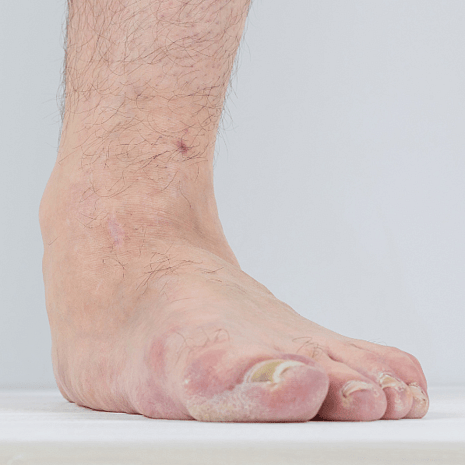 Specialist podiatry care for toenail problems including ingrown nails, fungal infections, trauma, and thickened nails at Foot Foundation