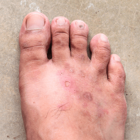 Specialist podiatry care for foot skin conditions including corns, calluses, warts, athlete&rsquo;s foot, cracked heels, and dermatitis at Foot Foundation