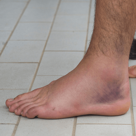 Specialist podiatry care for chronic ankle instability with balance training and orthotic support at Foot Foundation