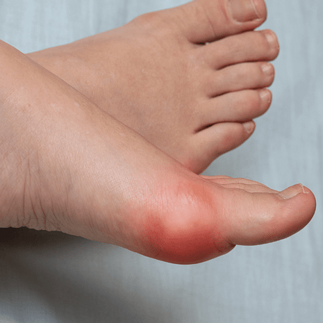 Specialist podiatry care for sesamoiditis and big toe joint pain with orthotics, padding, and rehabilitation at Foot Foundation