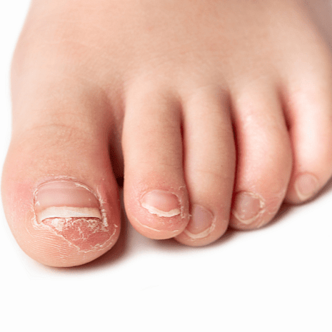 Specialist podiatry care for fungal nail infections with laser therapy, photodynamic therapy, and antifungal treatments at Foot Foundation