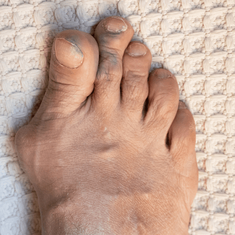 Specialist podiatry care for overlapping toes with separators, orthotics, footwear solutions, and rehabilitation at Foot Foundation