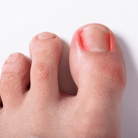 Specialist podiatry care for toe pain, deformities, and injuries with orthotics, splints, and rehabilitation at Foot Foundation