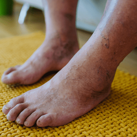 Foot Foundation podiatry care for diabetic foot complications with screening, ulcer prevention, and wound management