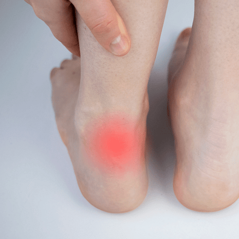 Foot with Achilles tendon pain highlighted in red, treated at Foot Foundation