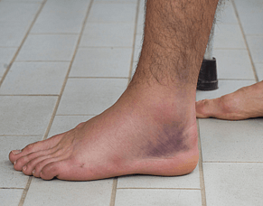 Why Your Ankle Keeps Giving Way