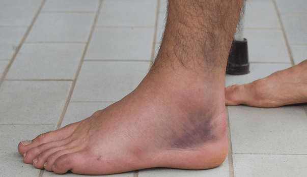Why Your Ankle Keeps Giving Way