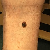 A lesion without dermatoscopy at Hamilton Skin Cancer Centre