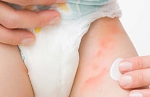 Nappy Rash