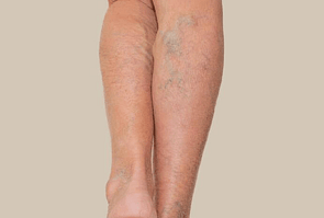 Bruising & Varicose Veins
