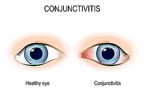 Eye Infections