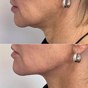 Neck & Jaw contouring - TruYou Appearance Medicine
