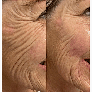 Dermal Filler - Cheeks & Lower Face