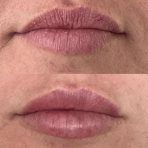 Dermal Filler - HA Lip Filler - TruYou Appearance Medicine