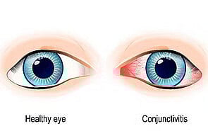 Eye Infections