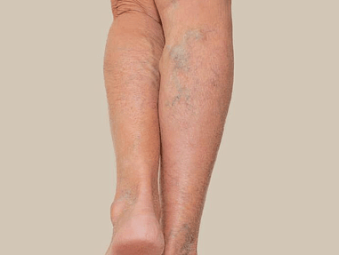 bruising & varicose veins