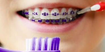 Orthodontic hygiene treatment (Cleaning braces)