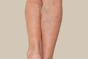 Bruising & Varicose Veins