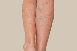Bruising & Varicose Veins