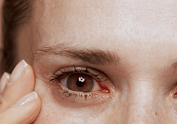 Eye Allergies Advice