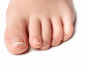 Fungal Nail Laser Treatment: How It Works and Results