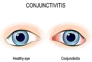 Eye Infections