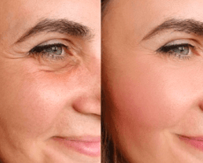 Skin Aging
