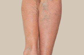 Bruising & Varicose Veins