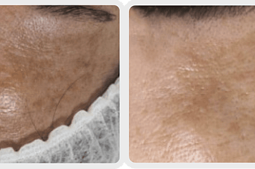 Observ Skin Analysis &ndash; Body Beautiful Retreat &ndash; Brisbane